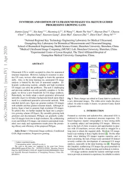 Synthesis and Edition of Ultrasound Images via Sketch Guided Progressive
  Growing GANs