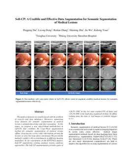 Soft-CP: A Credible and Effective Data Augmentation for Semantic
  Segmentation of Medical Lesions
